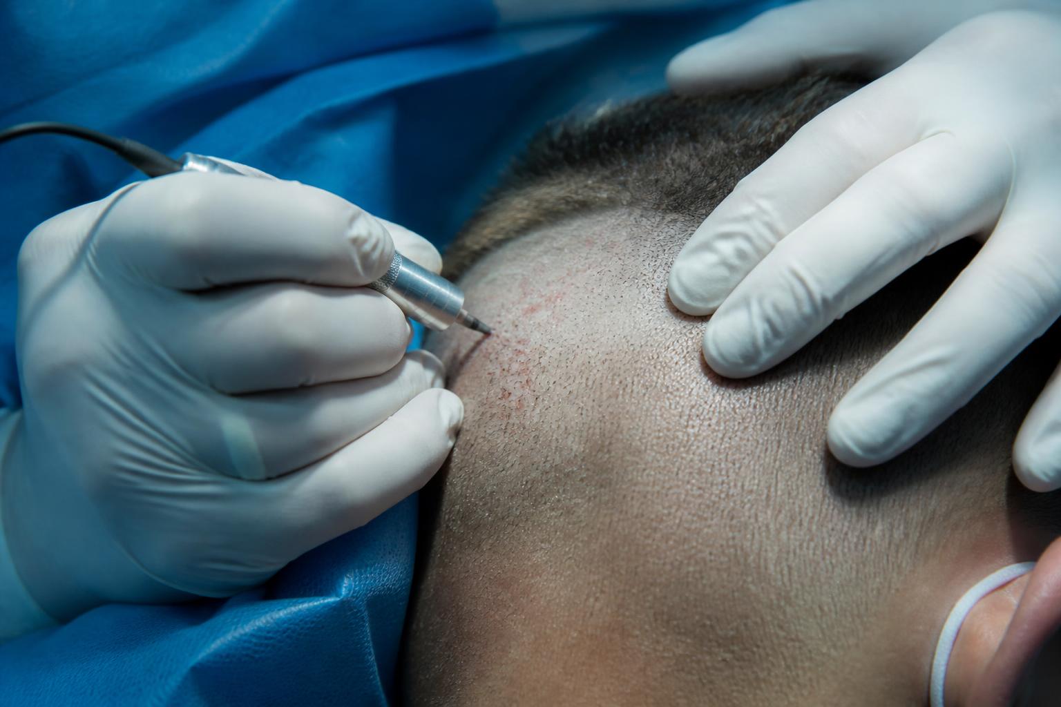 FUE hair transplant procedure